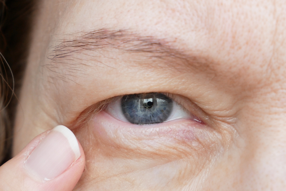 What To Do About Drooping Eyelids 1 Close up of person with droopy eyelids in Chesapeake, VA