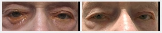 Before & After photo of Ectropion treatment