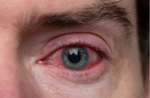 severe bloodshot eye conjunctivitis condition