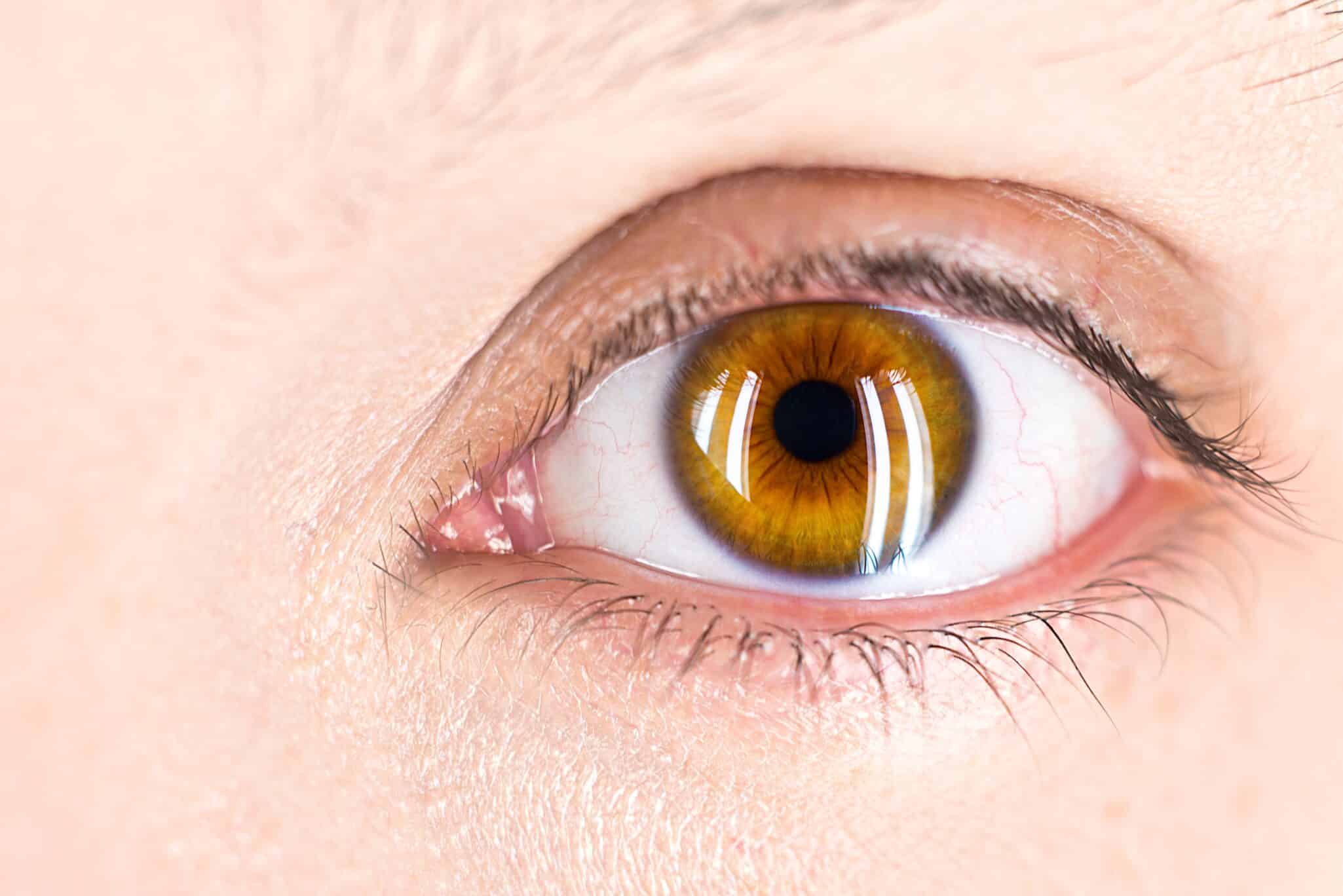 What Causes Eye Floaters? 1 Laser floater treatment