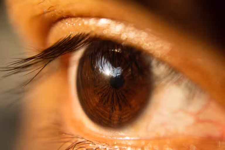 eyelid surgery eyelid surgery 11