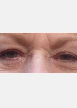 Blepharoplasty #4