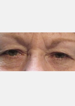 Blepharoplasty #4