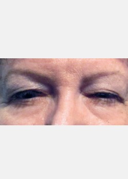 Blepharoplasty #2