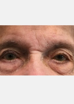 Ptosis Repair #1