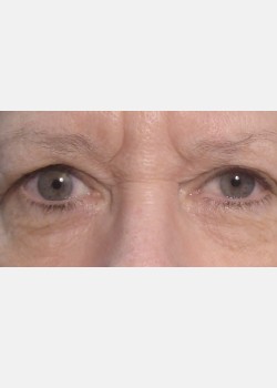 Ptosis Repair #2