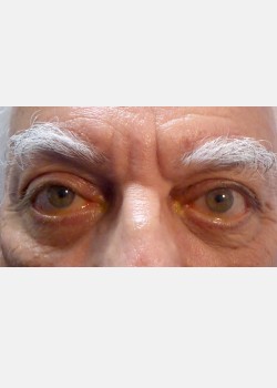 Direct Brow and Eyelid Repair #2