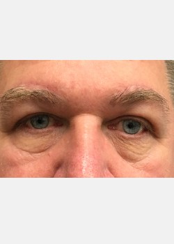 Direct Brow and Eyelid Repair #1