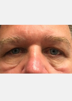 Direct Brow and Eyelid Repair #1
